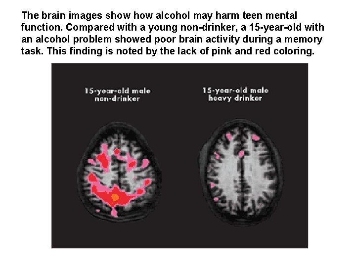 The brain images show alcohol may harm teen mental function. Compared with a young