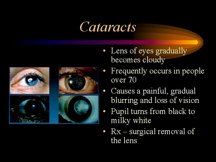 Cataracts • Lens of eyes gradually becomes cloudy • Frequently occurs in people over