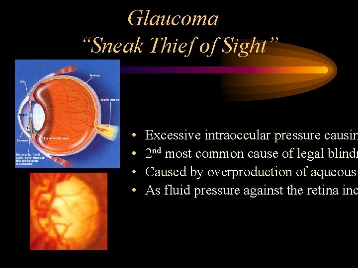 Glaucoma “Sneak Thief of Sight” • • • Excessive intraoccular pressure causin 2 nd