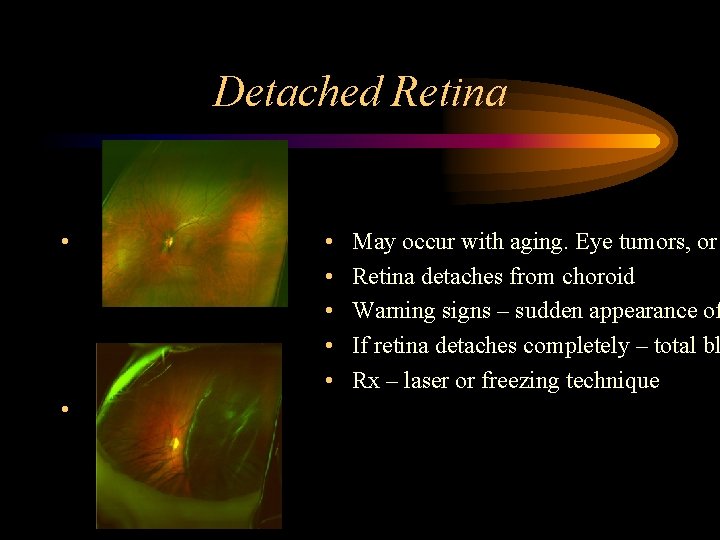 Detached Retina • • May occur with aging. Eye tumors, or Retina detaches from