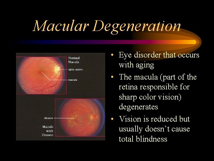 Macular Degeneration • Eye disorder that occurs with aging • The macula (part of