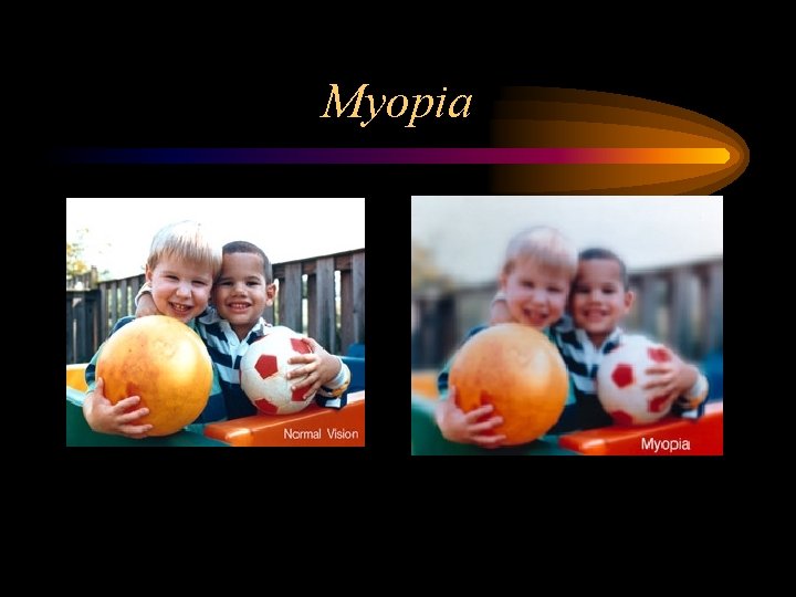 Myopia 