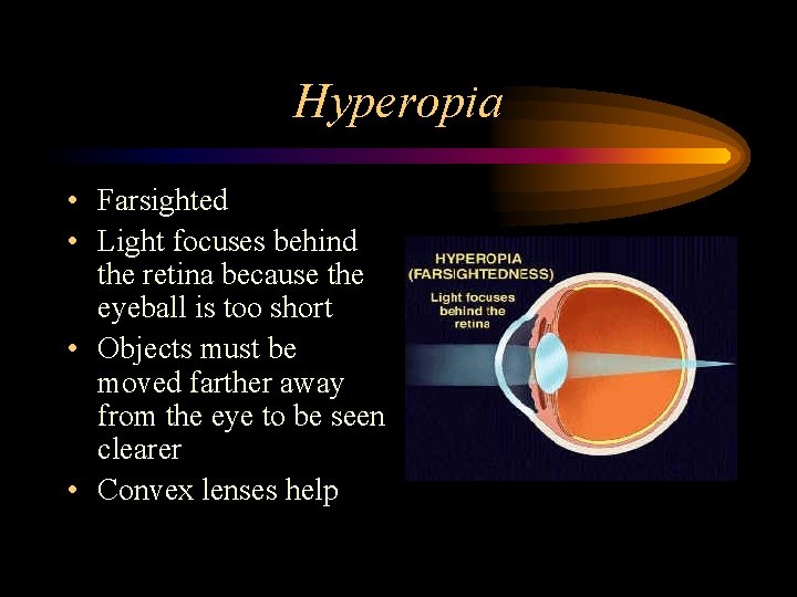 Hyperopia • Farsighted • Light focuses behind the retina because the eyeball is too
