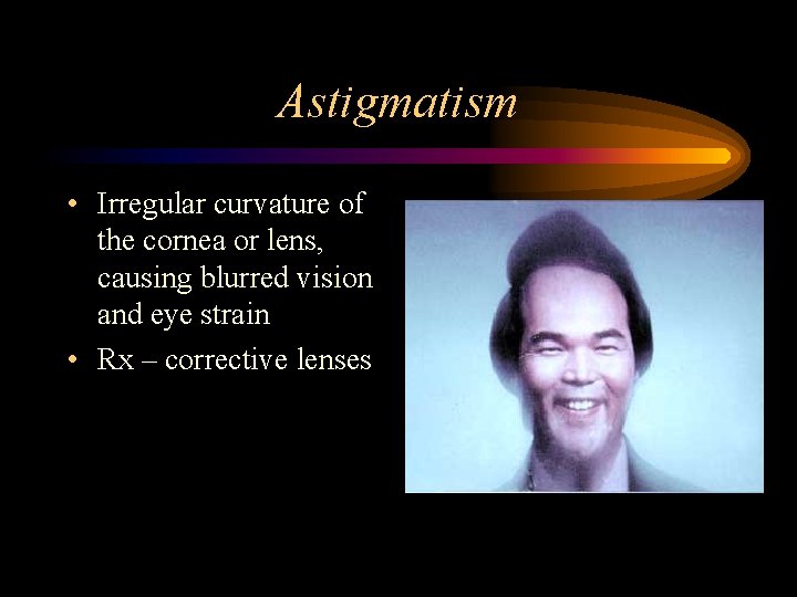 Astigmatism • Irregular curvature of the cornea or lens, causing blurred vision and eye