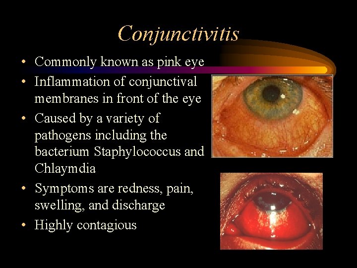 Conjunctivitis • Commonly known as pink eye • Inflammation of conjunctival membranes in front