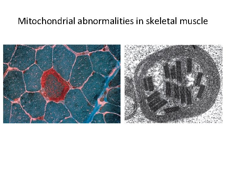 Mitochondrial abnormalities in skeletal muscle 