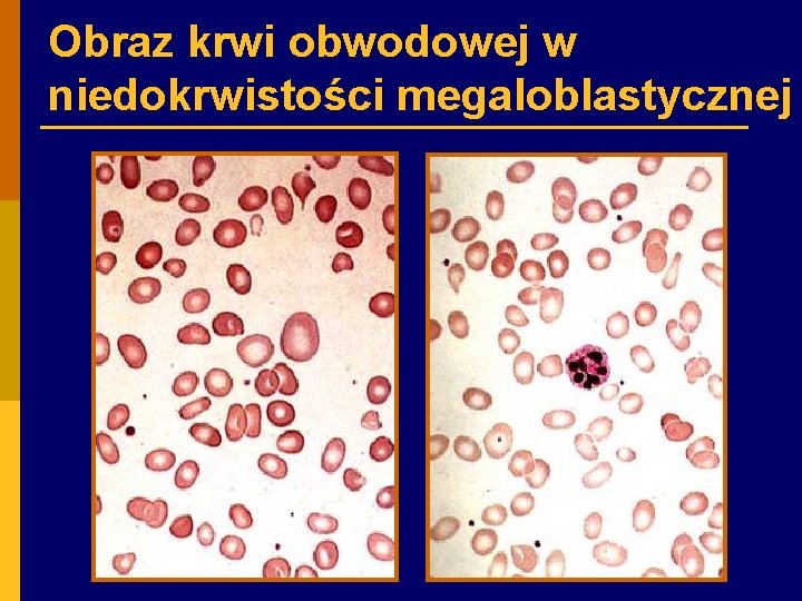 Obraz krwi obwodowej w niedokrwistości megaloblastycznej 