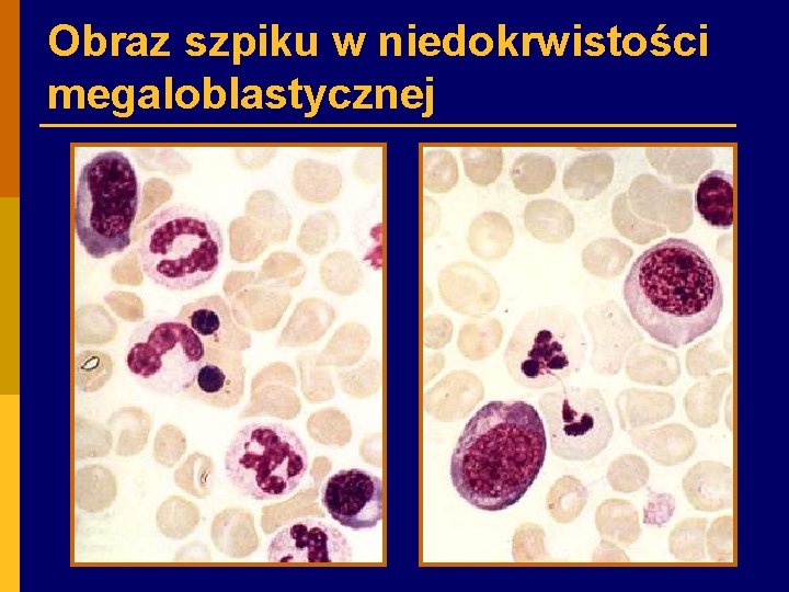 Obraz szpiku w niedokrwistości megaloblastycznej 