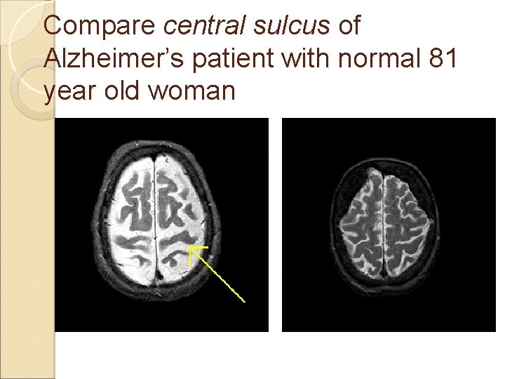 Compare central sulcus of Alzheimer’s patient with normal 81 year old woman 