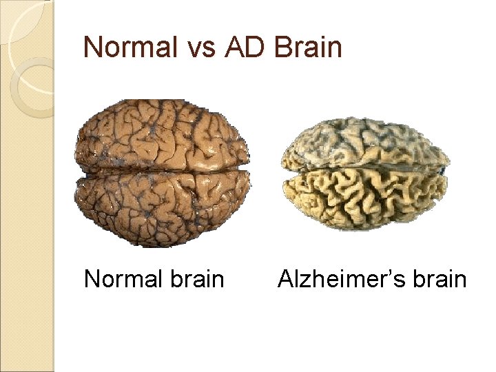 Normal vs AD Brain Normal brain Alzheimer’s brain 