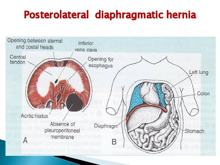 Posterolateral diaphragmatic hernia 