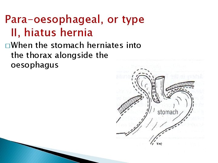 Para-oesophageal, or type II, hiatus hernia � When the stomach herniates into the thorax