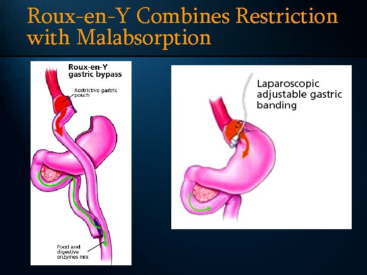 Roux-en-Y Combines Restriction with Malabsorption 