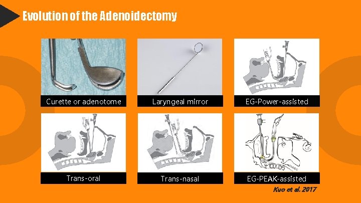 Evolution of the Adenoidectomy Curette or adenotome Laryngeal mirror EG-Power-assisted Trans-oral Trans-nasal EG-PEAK-assisted Kuo