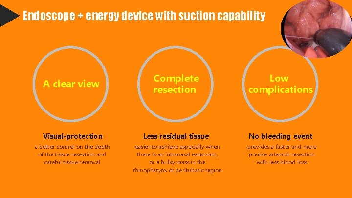 Endoscope + energy device with suction capability A clear view Complete resection Low complications