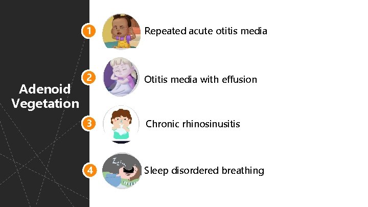 Adenoid Vegetation 1 Repeated acute otitis media 2 Otitis media with effusion 3 Chronic