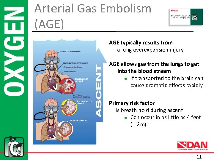 Arterial Gas Embolism (AGE) AGE typically results from a lung overexpansion injury AGE allows