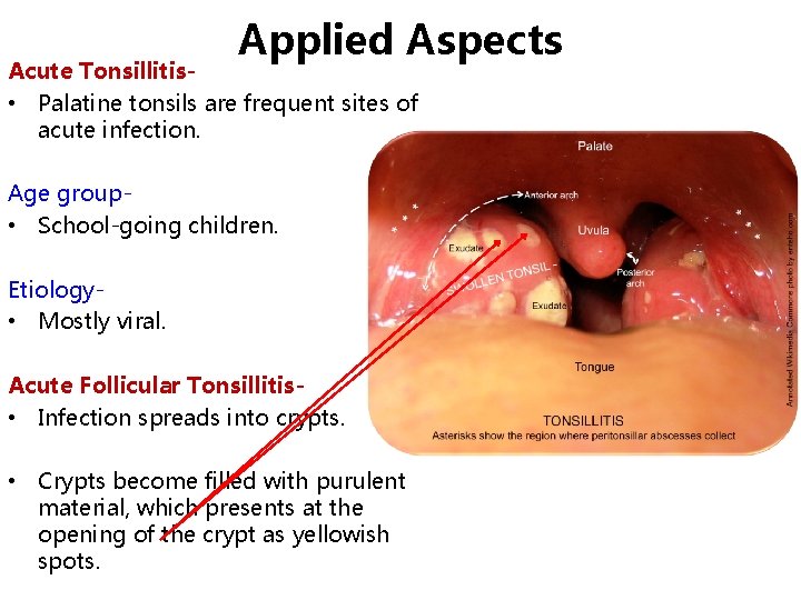 Applied Aspects Acute Tonsillitis • Palatine tonsils are frequent sites of acute infection. Age