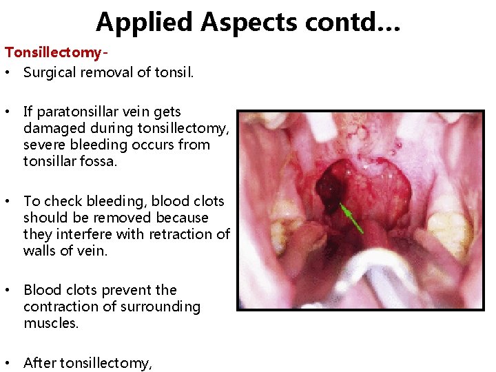 Applied Aspects contd… Tonsillectomy • Surgical removal of tonsil. • If paratonsillar vein gets