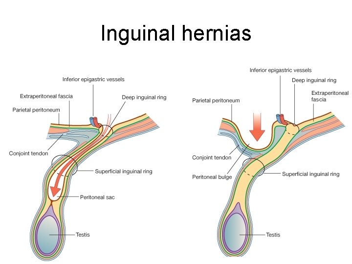 Inguinal hernias 