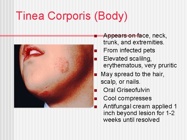 Tinea Corporis (Body) n n n n Appears on face, neck, trunk, and extremities.