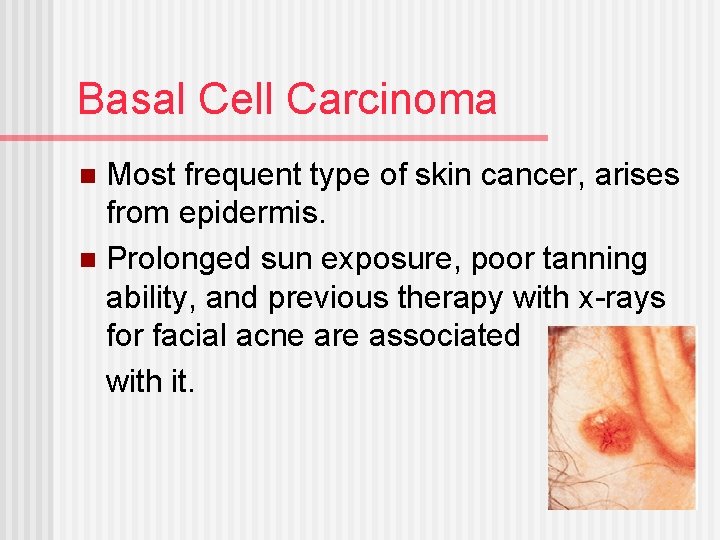 Basal Cell Carcinoma Most frequent type of skin cancer, arises from epidermis. n Prolonged