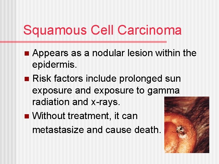 Squamous Cell Carcinoma Appears as a nodular lesion within the epidermis. n Risk factors