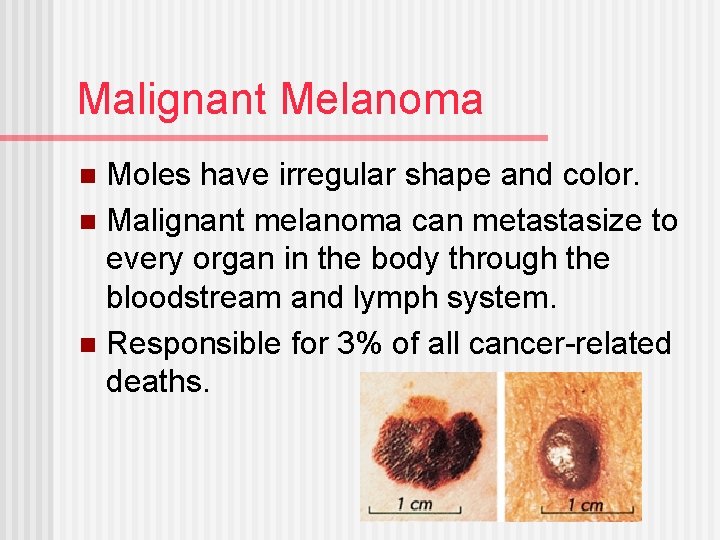 Malignant Melanoma Moles have irregular shape and color. n Malignant melanoma can metastasize to
