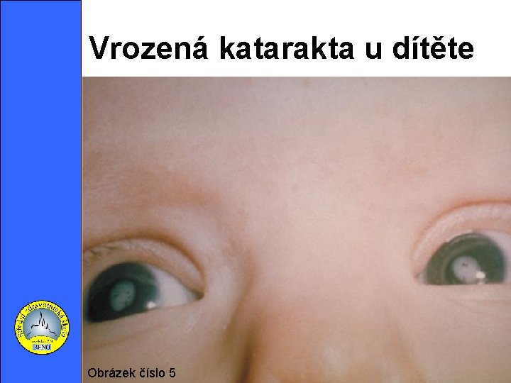 Vrozená katarakta u dítěte Obrázek číslo 5 