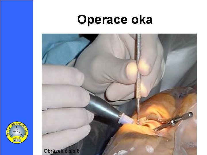 Operace oka Obrázek číslo 6 