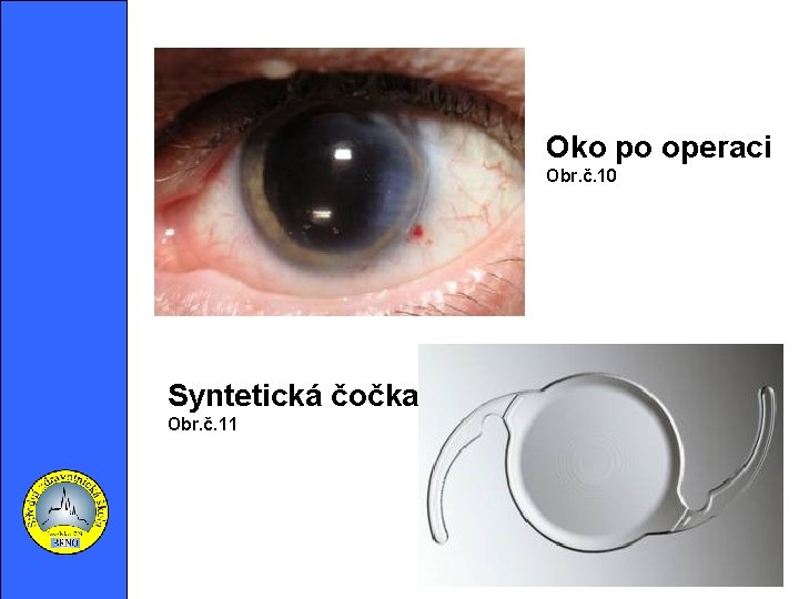 Oko po operaci Obr. č. 10 . Syntetická čočka Obr. č. 11 
