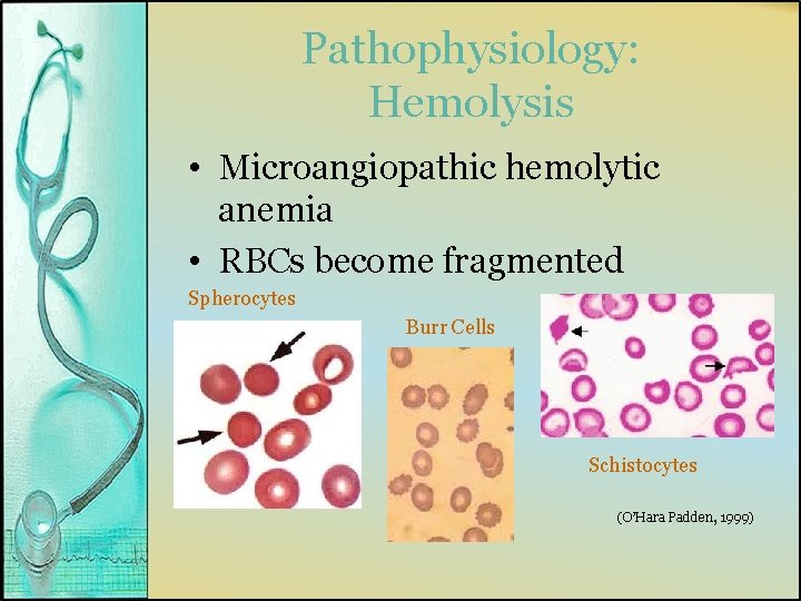 Pathophysiology: Hemolysis • Microangiopathic hemolytic anemia • RBCs become fragmented Spherocytes Burr Cells Schistocytes