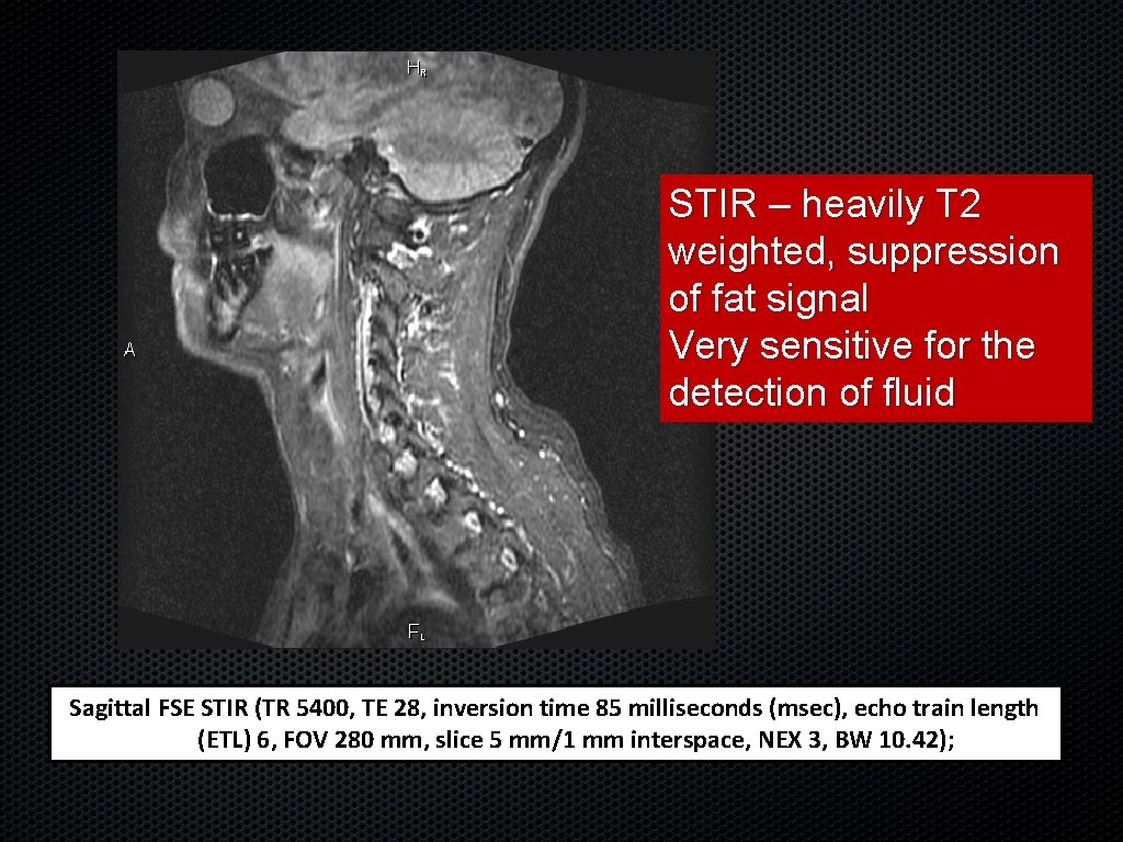 STIR – heavily T 2 weighted, suppression of fat signal Very sensitive for the