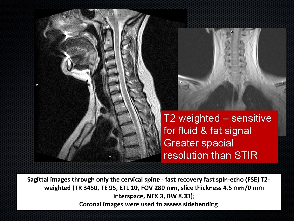 T 2 weighted – sensitive for fluid & fat signal Greater spacial resolution than