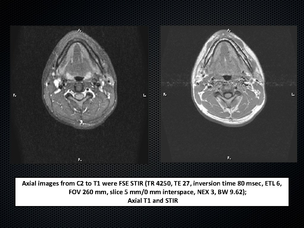 Axial images from C 2 to T 1 were FSE STIR (TR 4250, TE