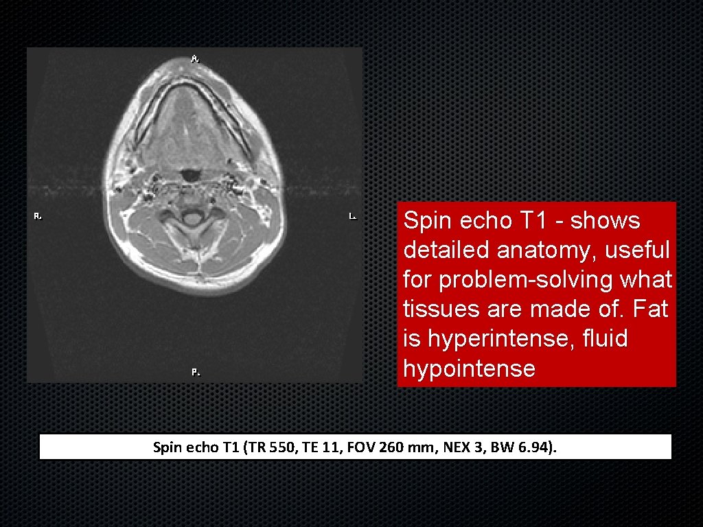 Spin echo T 1 - shows detailed anatomy, useful for problem-solving what tissues are