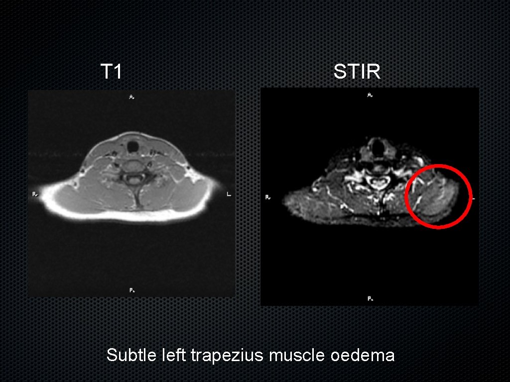 T 1 STIR Subtle left trapezius muscle oedema 