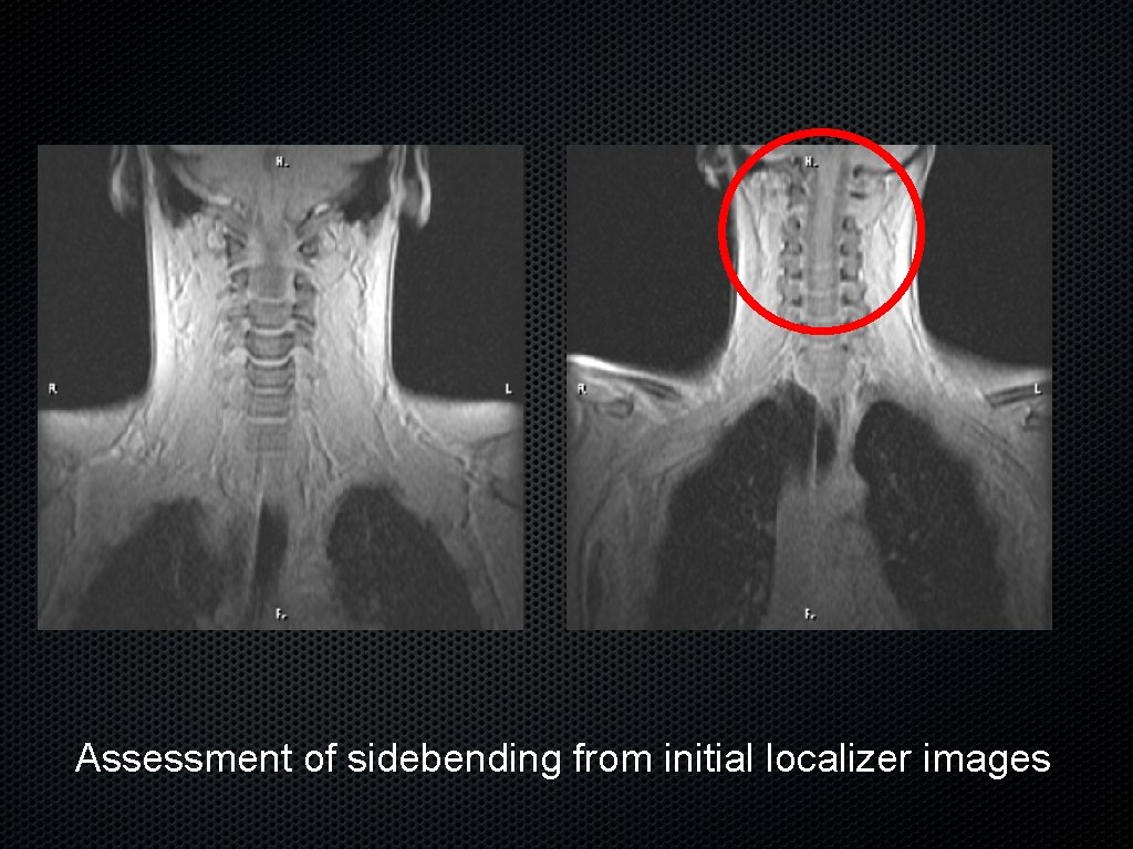 Assessment of sidebending from initial localizer images 
