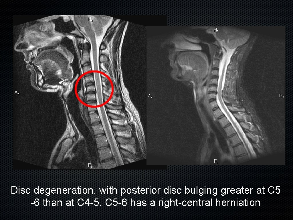 Disc degeneration, with posterior disc bulging greater at C 5 -6 than at C