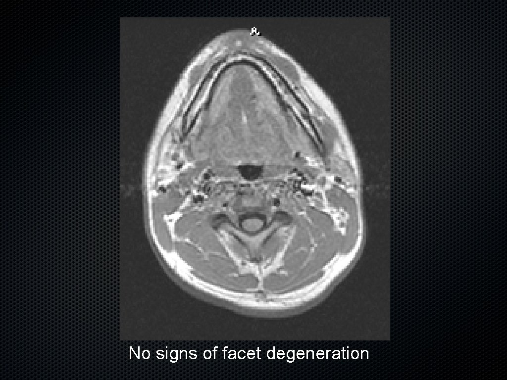 No signs of facet degeneration 