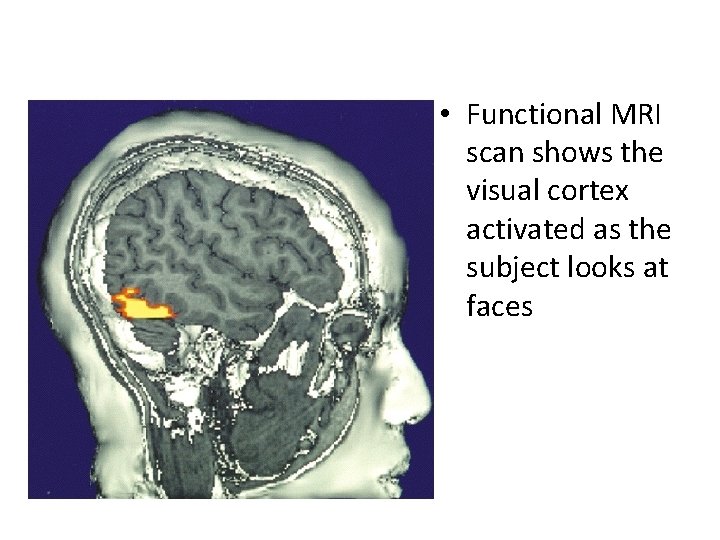  • Functional MRI scan shows the visual cortex activated as the subject looks