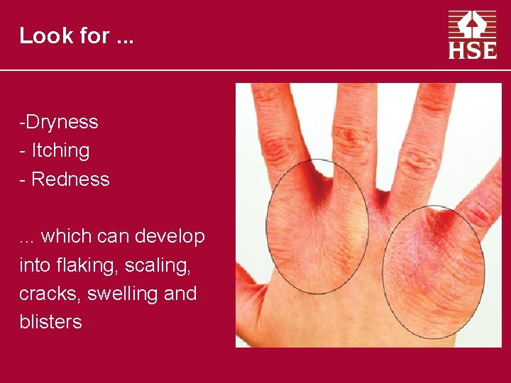 Look for. . . -Dryness - Itching - Redness. . . which can develop