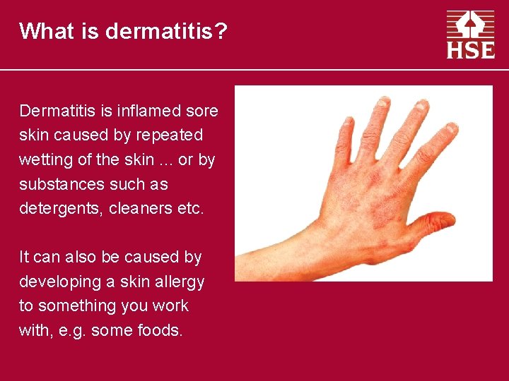 What is dermatitis? Dermatitis is inflamed sore skin caused by repeated wetting of the