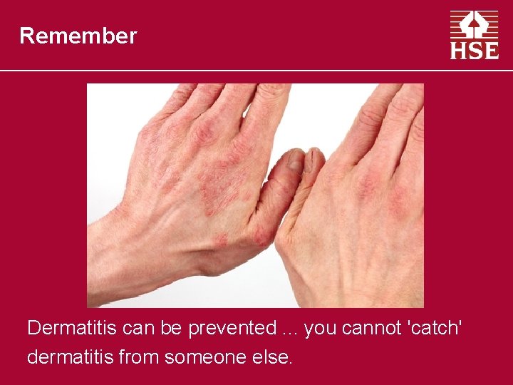 Remember Dermatitis can be prevented. . . you cannot 'catch' dermatitis from someone else.