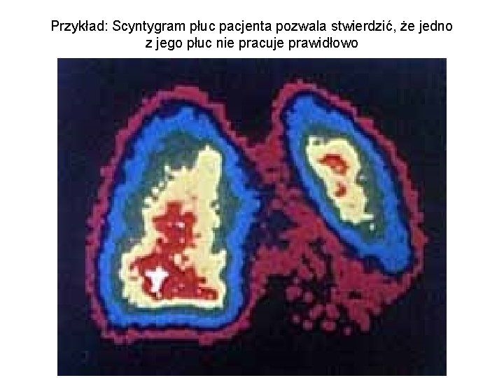 Przykład: Scyntygram płuc pacjenta pozwala stwierdzić, że jedno z jego płuc nie pracuje prawidłowo