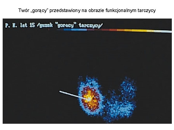 Twór „gorący” przedstawiony na obrazie funkcjonalnym tarczycy 