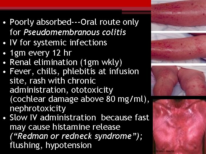  • Poorly absorbed---Oral route only for Pseudomembranous colitis • IV for systemic infections