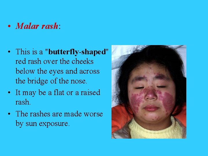  • Malar rash: • This is a "butterfly-shaped" red rash over the cheeks