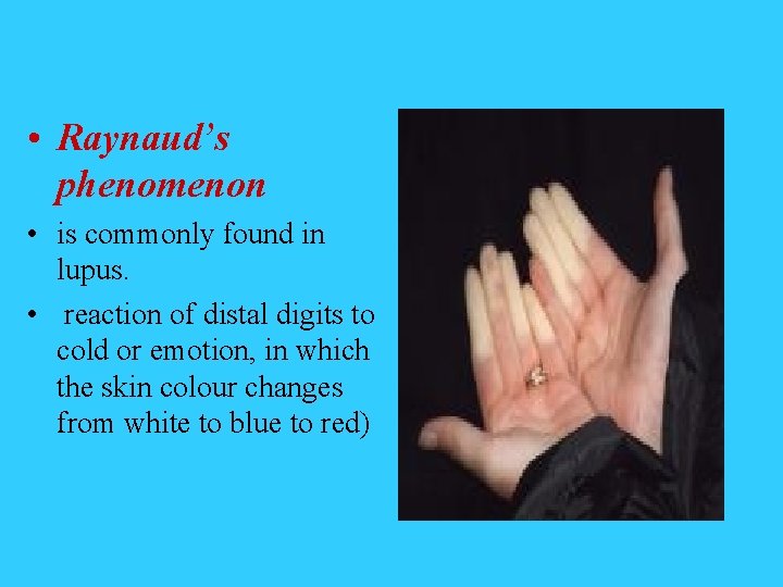  • Raynaud’s phenomenon • is commonly found in lupus. • reaction of distal