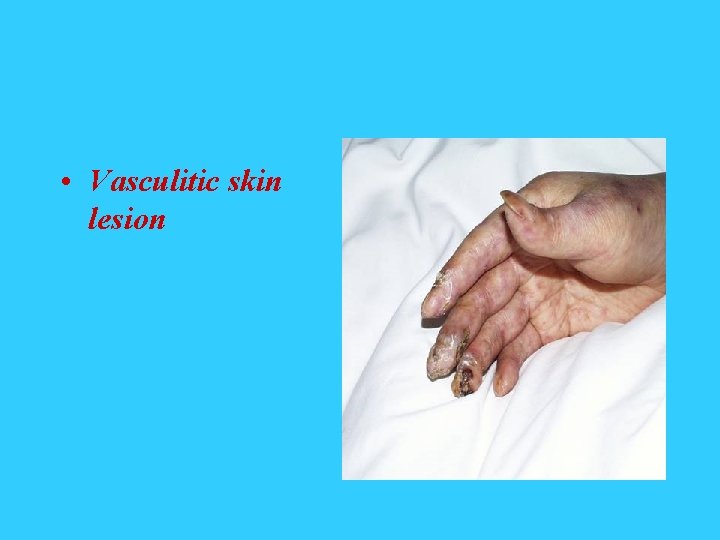  • Vasculitic skin lesion 